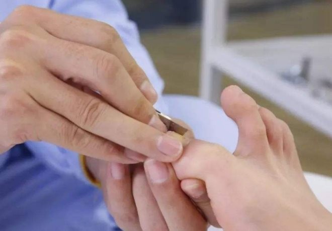 祁仁堂灰指甲足療修腳